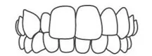 Crossbite