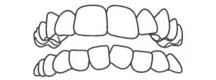 Crowded Teeth