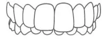 Overbite