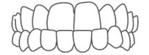 Underbite