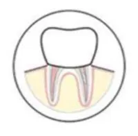 New Crown Cemented onto Rebuilt Tooth