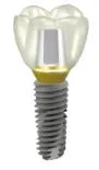 Implant