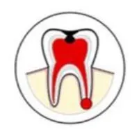 Infected Tooth