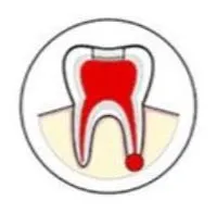 Opening made in the Tooth