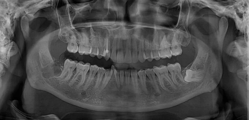 Impacted Wisdom Teeth
