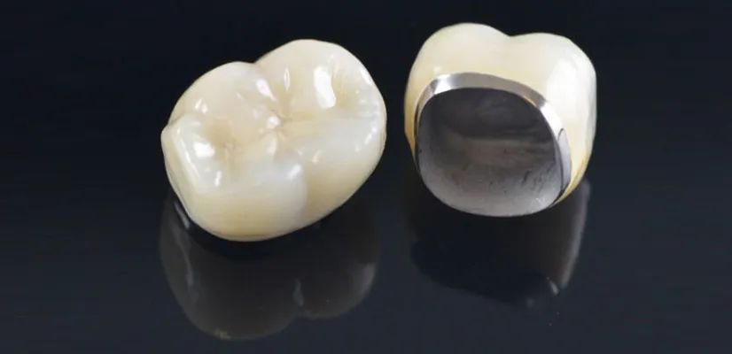 PFM Crowns